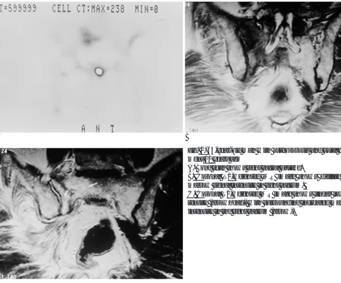 Fig. 2. 63-year-old man with osteoporosis and total hip replace- replace-ment 10 years ago