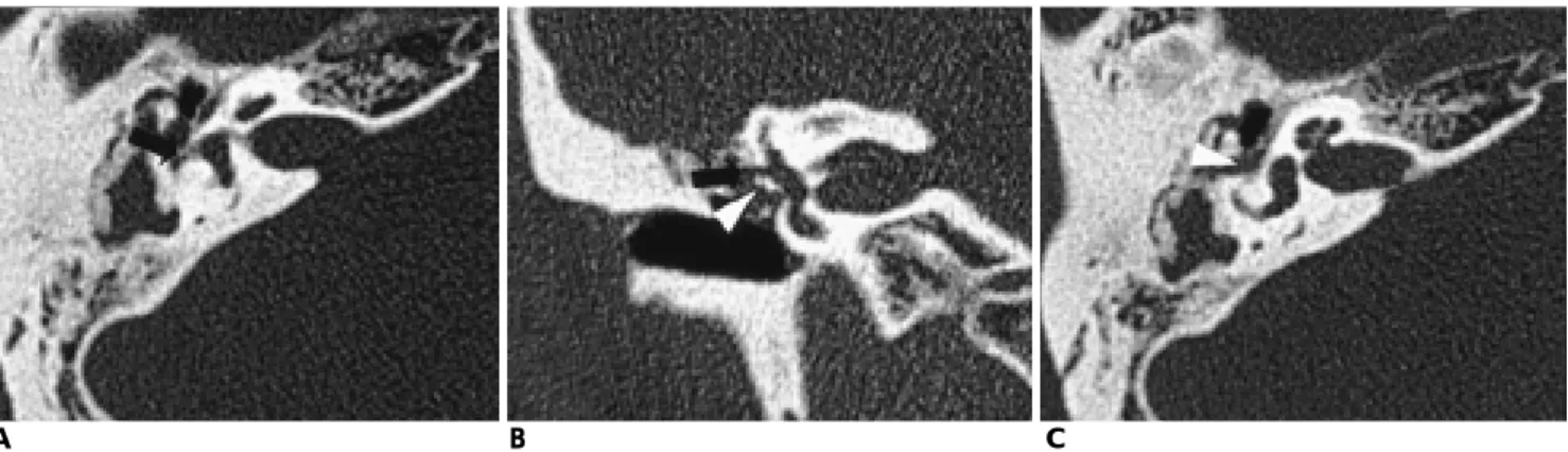 Fig. 1. Cholesteatoma; Erosion of lateral semicircular canal and facial canal.