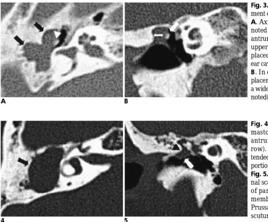 Fig. 4. Cholesteatoma; Ballooning of mastoid antrum. Axial scan. Mastoid antrum was markedly ballooned  (ar-row)