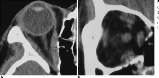 Table 2. Mean thickness of Extraocular Muscle for Normal Control Group and Thyroid Ophthalmopathy 