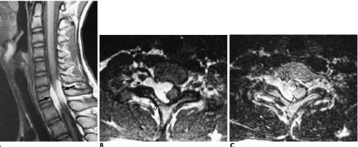 Fig. 2. A 15-year-old boy with neck pain and right arm weakness (case 2).
