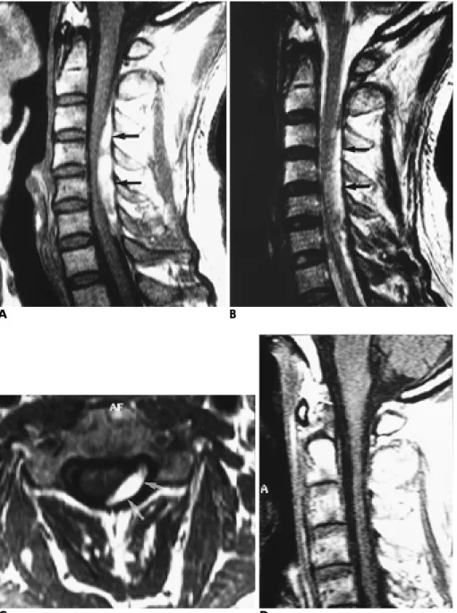 Fig. 3. A 55-year-old man with abruptly developed neck pain and left upper  ex-tremity weakness (case 3).
