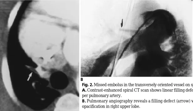Table 2. Detection of Pulmonary Embolism on Pulmonary A n g i o g r a p h y