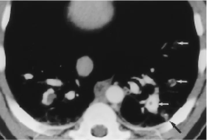 Table 4. Sensitivity, Specificity and Accuracy of Pulmonary Angiography in the Diagnosis of Pulmonary Embolism