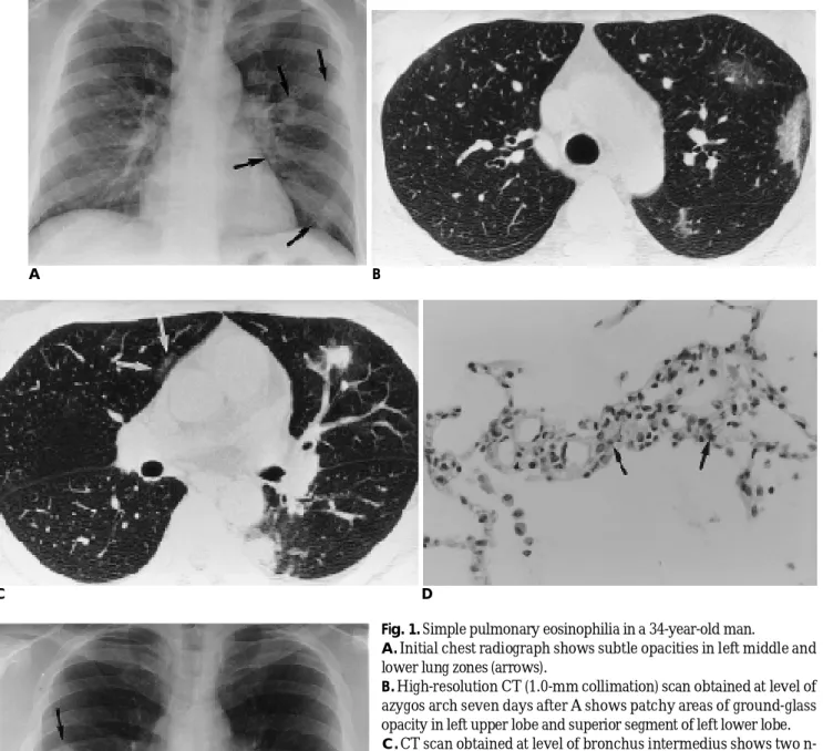 Fig. 1. Simple pulmonary eosinophilia in a 34-year-old man.