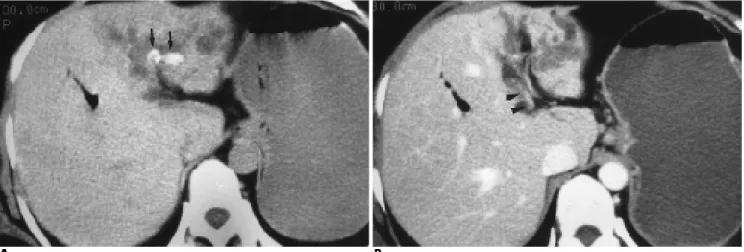 Fig. 3. A 36-year-old woman with recurrent pyogenic cholangitis.