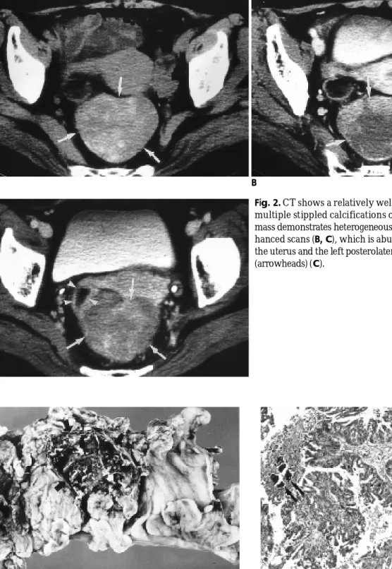 Fig. 3. Gross specimen of the lesion. Relatively well circum- circum-scribed cystic mass, about 7×6cm in diameter, is present on the serosal surface of the rectum