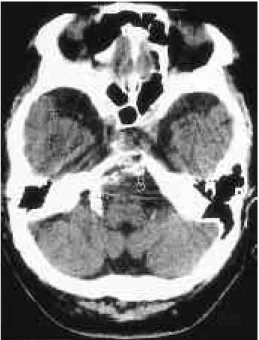 Fig. 1. 63-years old male patient presenting dizziness(Type 1) Precontrast CT scan shows tortuous ectatic distal vertebral artery with dense arterial wall calcification(open white  ar-rows)