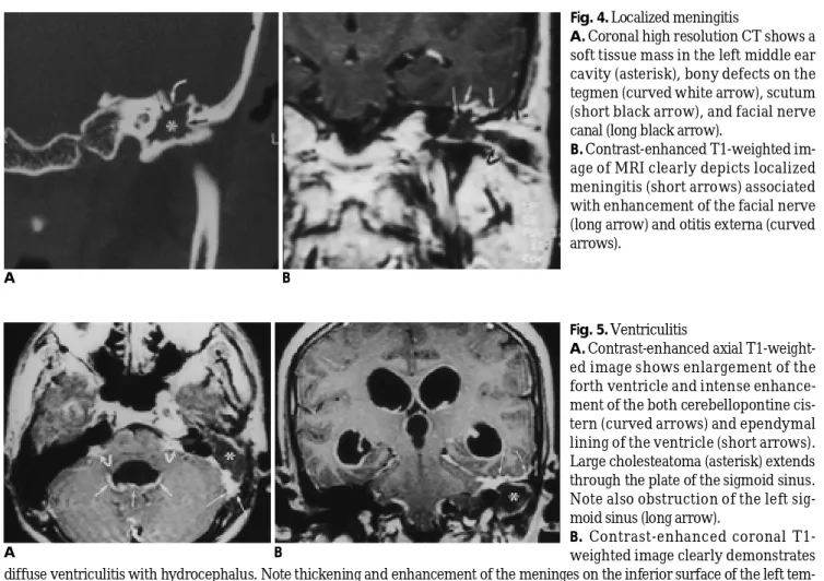 Fig. 4. Localized meningitis