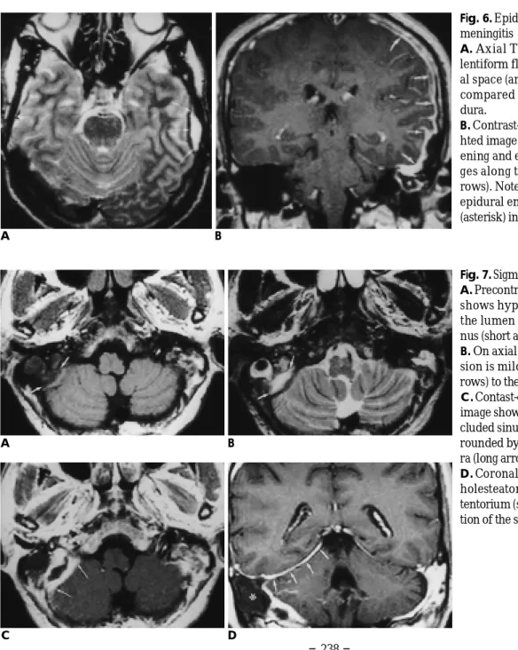 Fig. 6. Epidural empyema with diffuse m e n i n g i t i s