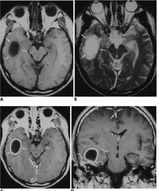 Fig. 8. Brain abscess and subdural em- em-p y e m a