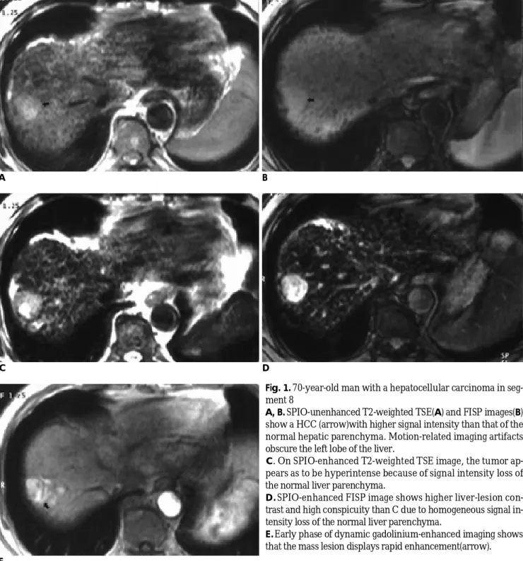 Fig. 1. 70-year-old man with a hepatocellular carcinoma in seg- seg-ment 8