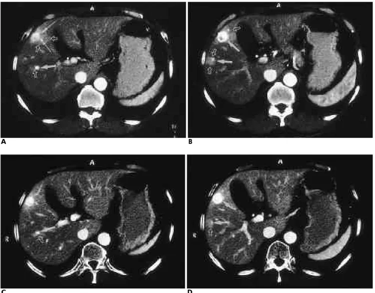 Fig. 2. Three hemangiomas with wedge-shaped parenchymal enhancements in the periphery to the tumors in a 70-year-old man.
