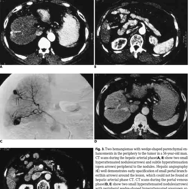 Fig. 3. Two hemangiomas with wedge-shaped parenchymal en- en-hancements in the periphery to the tumor in a 56-year-old man.