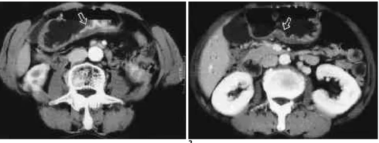 Fig. 1. A 42-year-old man with benign gastric ulcer.