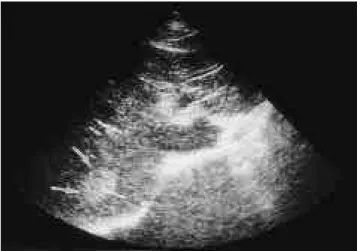 Fig. 1. Typical hemangioma on US.