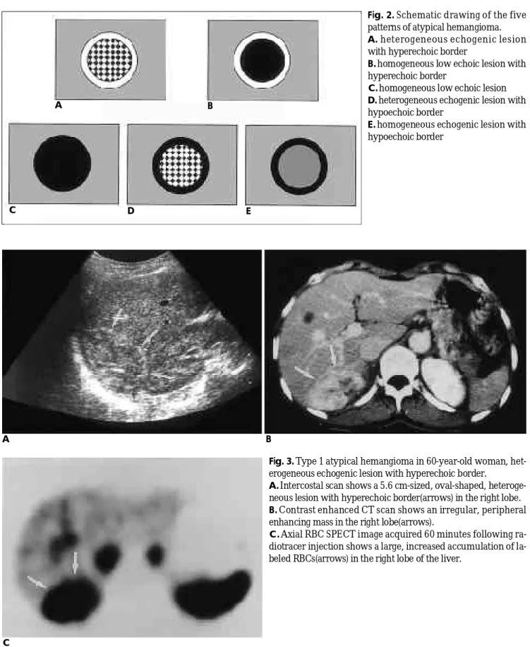 Fig. 2. Schematic drawing of the five patterns of atypical hemangioma.