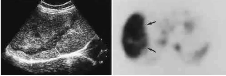 Fig. 7. Type 4 atypical hemangioma in 40-year-old woman, heterogeneous echogenic lesion with hypoechoic border.