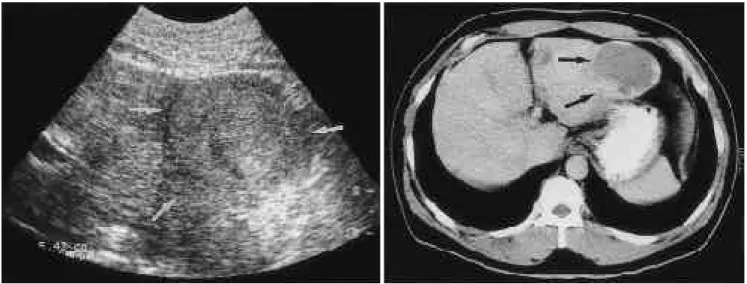 Fig. 9. Type 5 atypical hemangioma, homogeneous echogenic lesion with hypoechoic border.