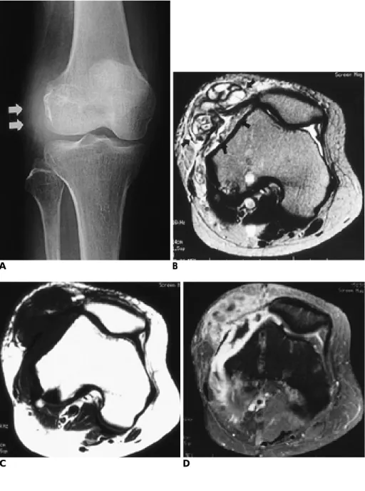 Fig. 1. A 55-year-old woman with his- his-tory of rheumatoid arthritis.