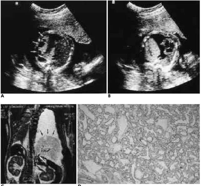 Fig. 1. A. Transverse sonogram of fetal chest shows a huge echogenic mass with multiple variable sized cyst (white arrows) that oc- oc-cupied the left lower chest