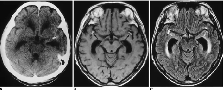 Table 1. Comparison of FLAIR MR Image with CT and T1- T1-Weighted MR Image(T1WI) (mean score)