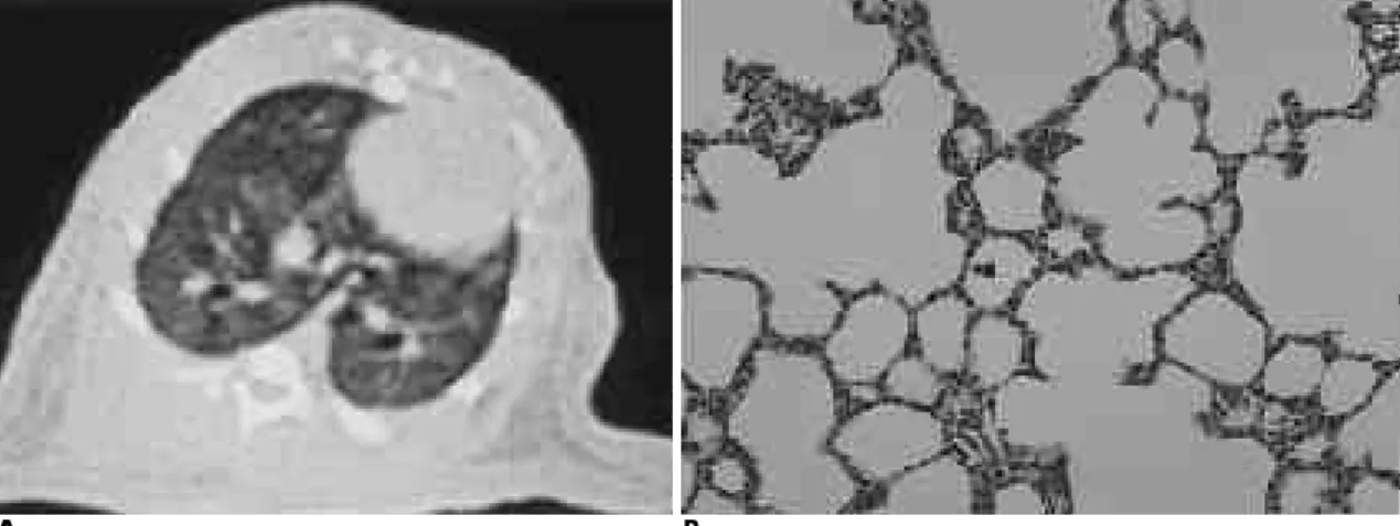 Fig. 4. High resolution CT(A) of control group shows no ground glass opacity, and consolidation