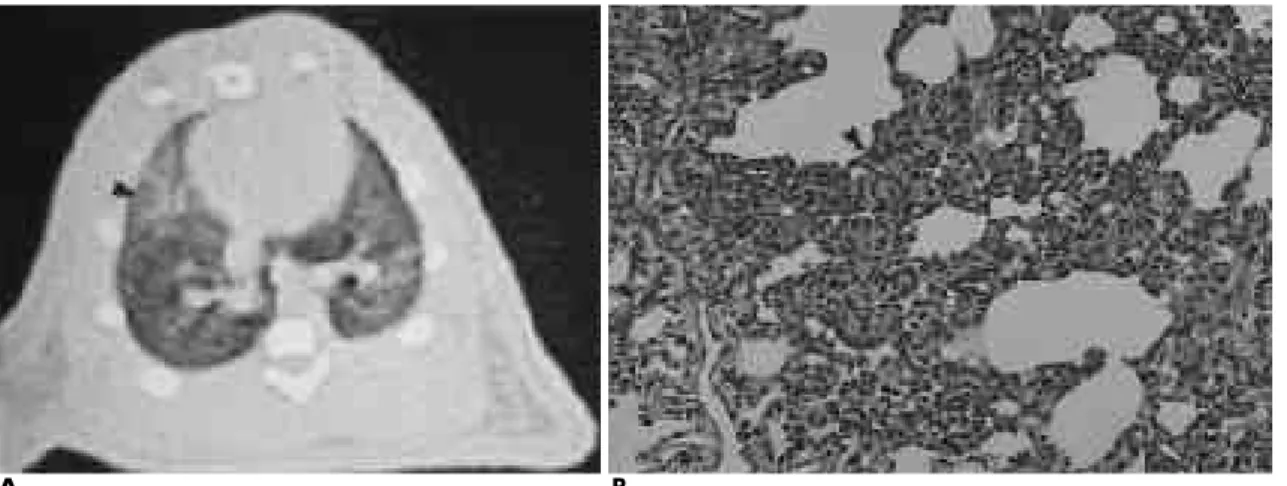 Fig. 6. High resoultion CT (A) of group II shows patchy increased opacity in the anterio-peripheral portion of right lower lung(ar- lung(ar-row)