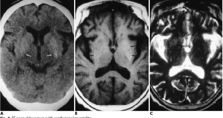 Fig. 2. 75-year-old woman with confusional mentality.
