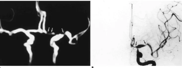 Fig. 3. Complete occlusion of right middle cerebral artery on both MR angiogram and conventional angiogram.