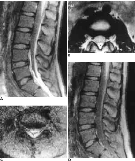 Fig. 1. A  13-year-old  male (patient  1) with lower back and saddle area pain beginning at posttraumatic 4th day.