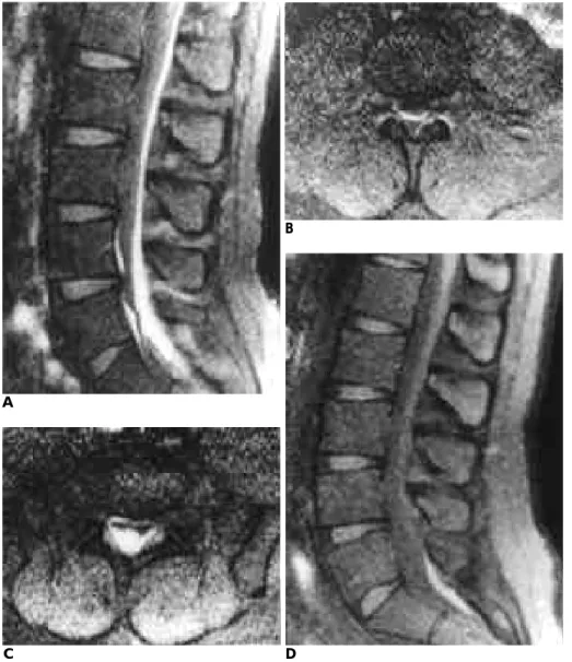 Fig. 2. A  28-year-old male  (patient  4) with  paresthesia  in  saddle  area  and both  legs  beginning  at  posttraumatic 15th day.