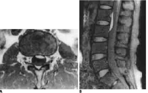 Fig. 3.  A  50-year-old  male(patient  3) with paresthesia in right leg beginning at the posttraumatic 12th day.