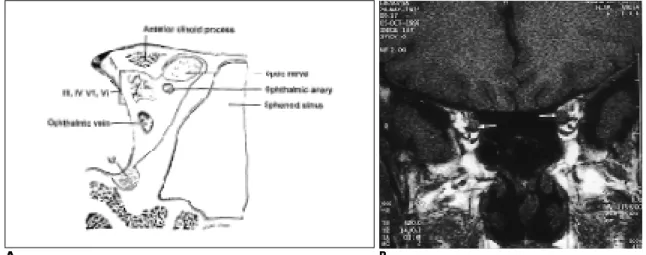 Fig. 1. A. Schematic drawing of coronal anatomy of the orbital apex. The optic nerve and ophthalmic artery pass through the optic canal