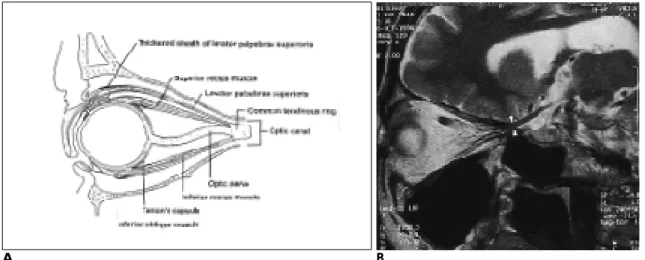 Fig.  2. A.Schematic drawing of transverse anatomy of the orbital apex through the optic canal.