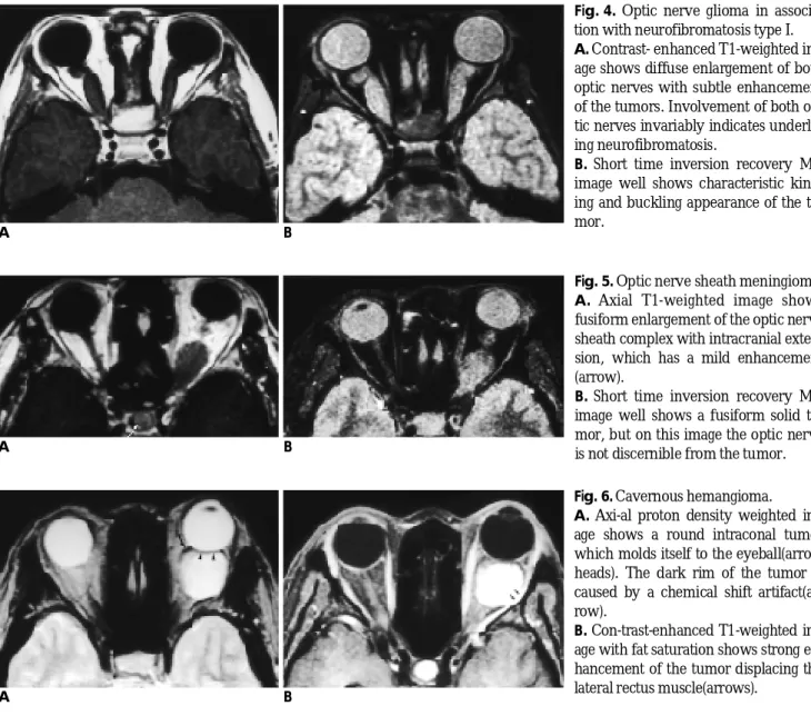 Fig. 6. Cavernous hemangioma. 