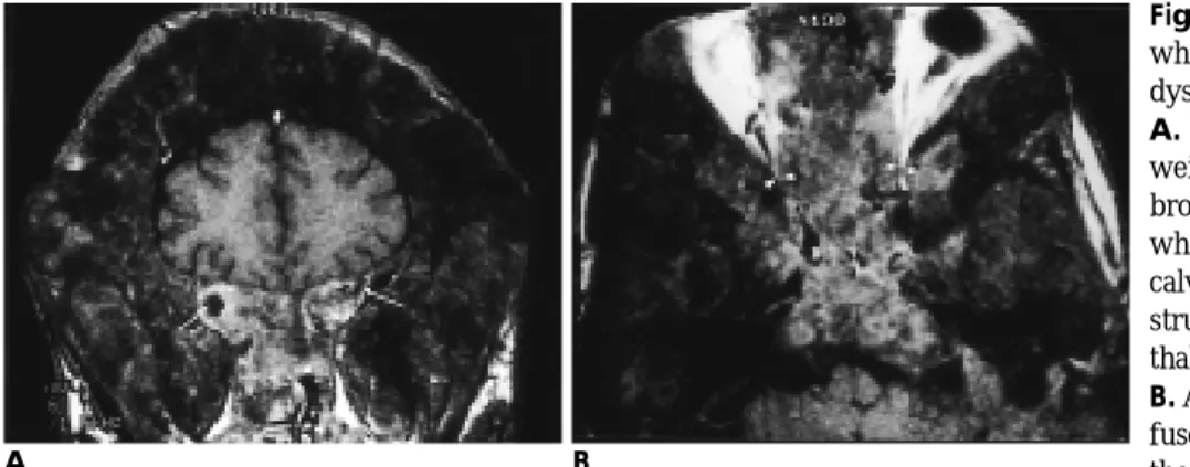 Fig.  7. McCune-Albright  syndrome which  consists  of  polyostotic  fibrous dysplasia  and  endocrine  dysfunction.