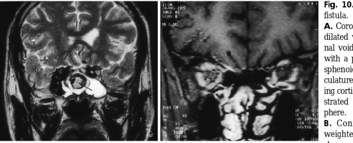 Fig. 11. Thrombophlebitis  of  the  cav- cav-ernous sinus. 