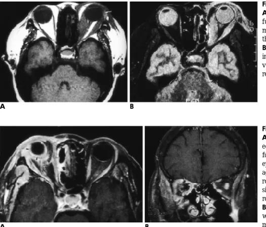 Fig. 12. Pseudotumor of the orbit. 