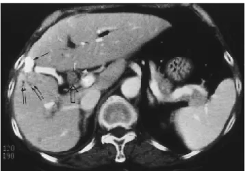 Fig. 1. Small parenchymal tumor with extensive intraductal growth in 68-year-old female who had been treated with transarterial chemoembolization(TACE) once and  percuta-neous ethanol injection therapy(PEIT) twice.
