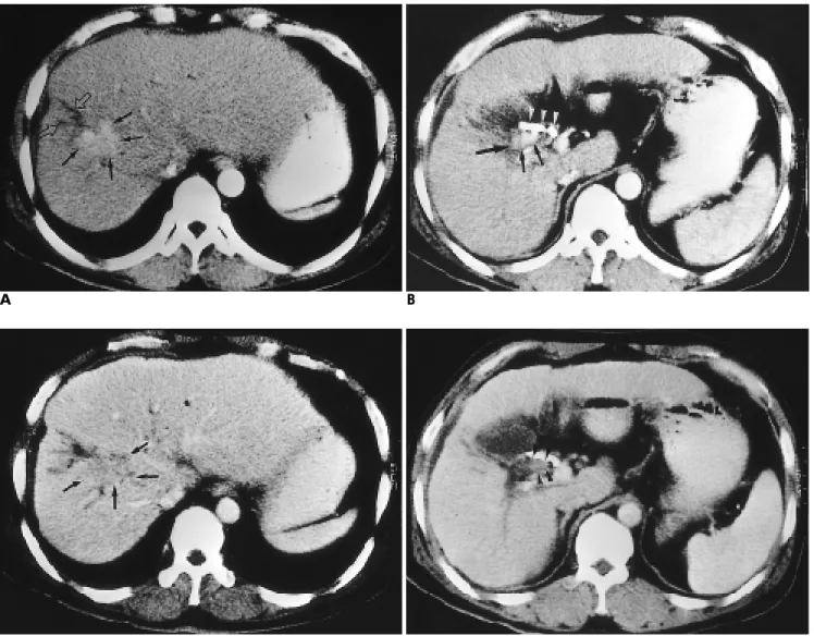 Fig. 3. HCC growing into the CBD in 48-year-old male, confirmed by hilar dissection and S5,8 subsegmentectomy.