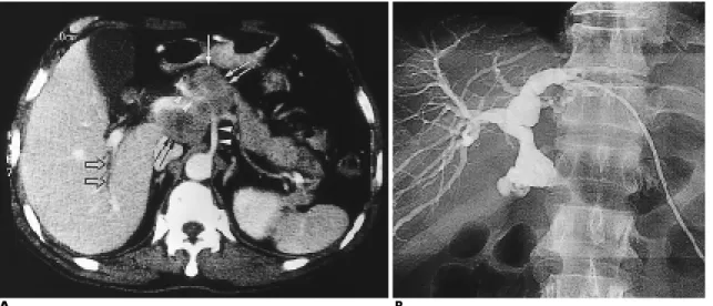 Fig. 4. Metastatic hilar lymph node from hepatocellular carcinoma with bile duct compression in 60-year-old male.