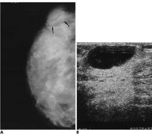 Fig. 1. A 27-year-old woman who not- not-ed a breast mass 4 months after  deliv-ery.  (A)  Craniocaudal  view  of   mam-mography shows a lobulating,  homoge-neous  high  density  mass  (arrows)  in the 12-o’clock axis of her right breast.