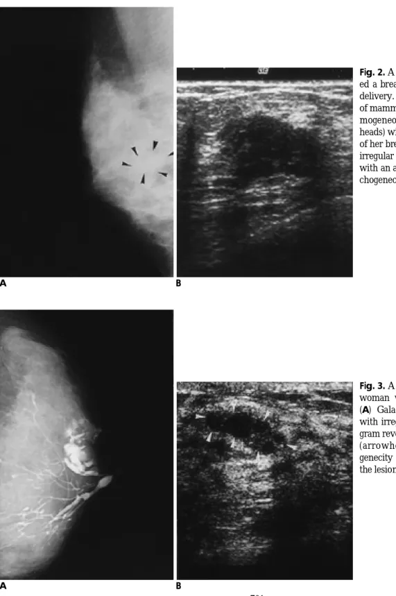Fig. 2. A 40-year-old woman who not- not-ed a breast mass 9 years after the last delivery