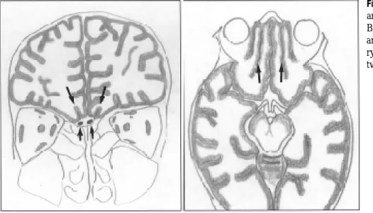 Fig.  3. Schematic  drawing  of  frontal area, coronal and axial view.