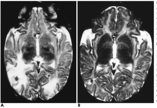 Fig. 2. Microscopic findings of central portion of abscess re- re-veals some branched septated hyphal element(arrows) and necrotic materials, suggesting fungal hyphae.(PAS stain, ＋×
