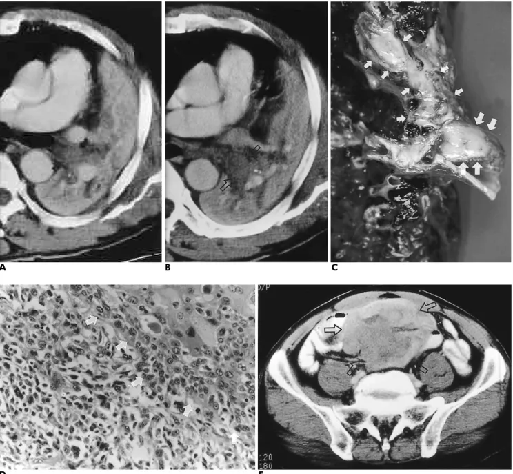Fig. 1. 56-year-old man with endobronchial sarcomatoid carcinoma 