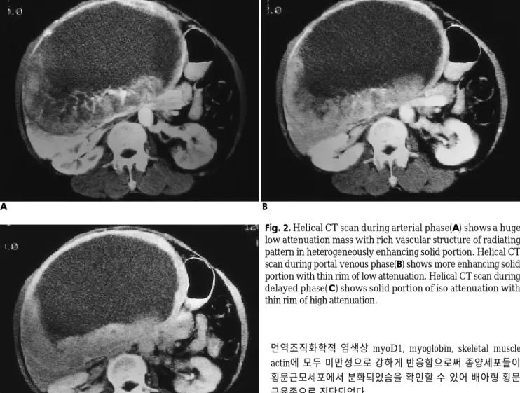 Fig. 2. Helical CT scan during arterial phase(A) shows a huge low attenuation mass with rich vascular structure of radiating pattern in heterogeneously enhancing solid portion
