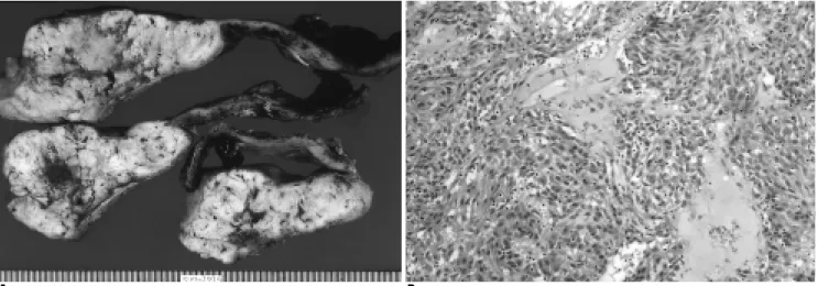 Fig. 4.A. Cut sections of the tumor demonstrate creamy yellow solid components, hemorrhagic to necrotic, fish-flesh appearance and extensive cystic degeneration.