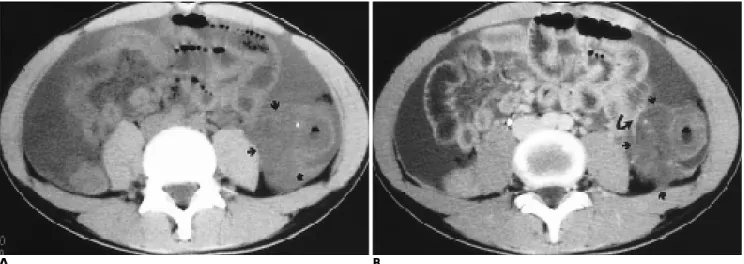Fig. 2. A .Precontrast CT scan shows massive ascites and a large soft tissue mass with small calcification in the descending colon (arrows)